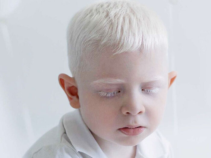 هر آنچه باید در مورد آلبینیسم یا زالی بدانید